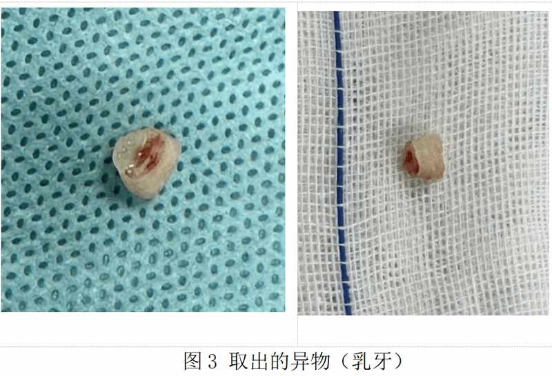 1岁宝宝误呛乳牙,反复肺炎50天!春节气道异物防护指南,家长必看 新闻